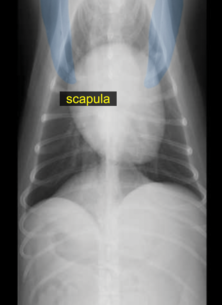 Radiographic image of a scapula.